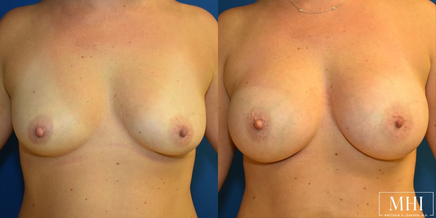 Breast Augmentation - Case 12118