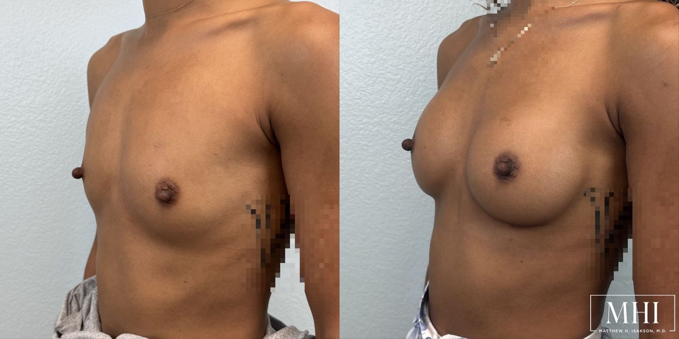 Breast Augmentation - Thumbnail 2