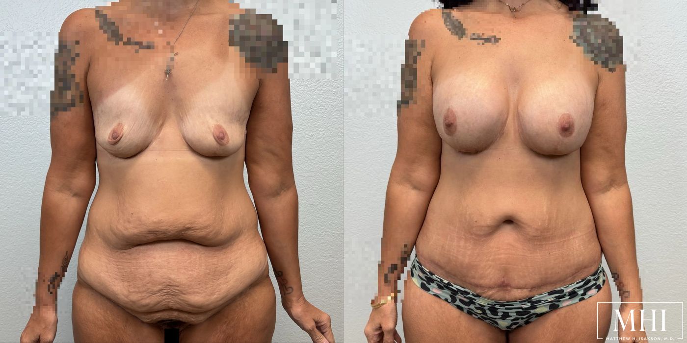 Breast Augmentation - Case 12120