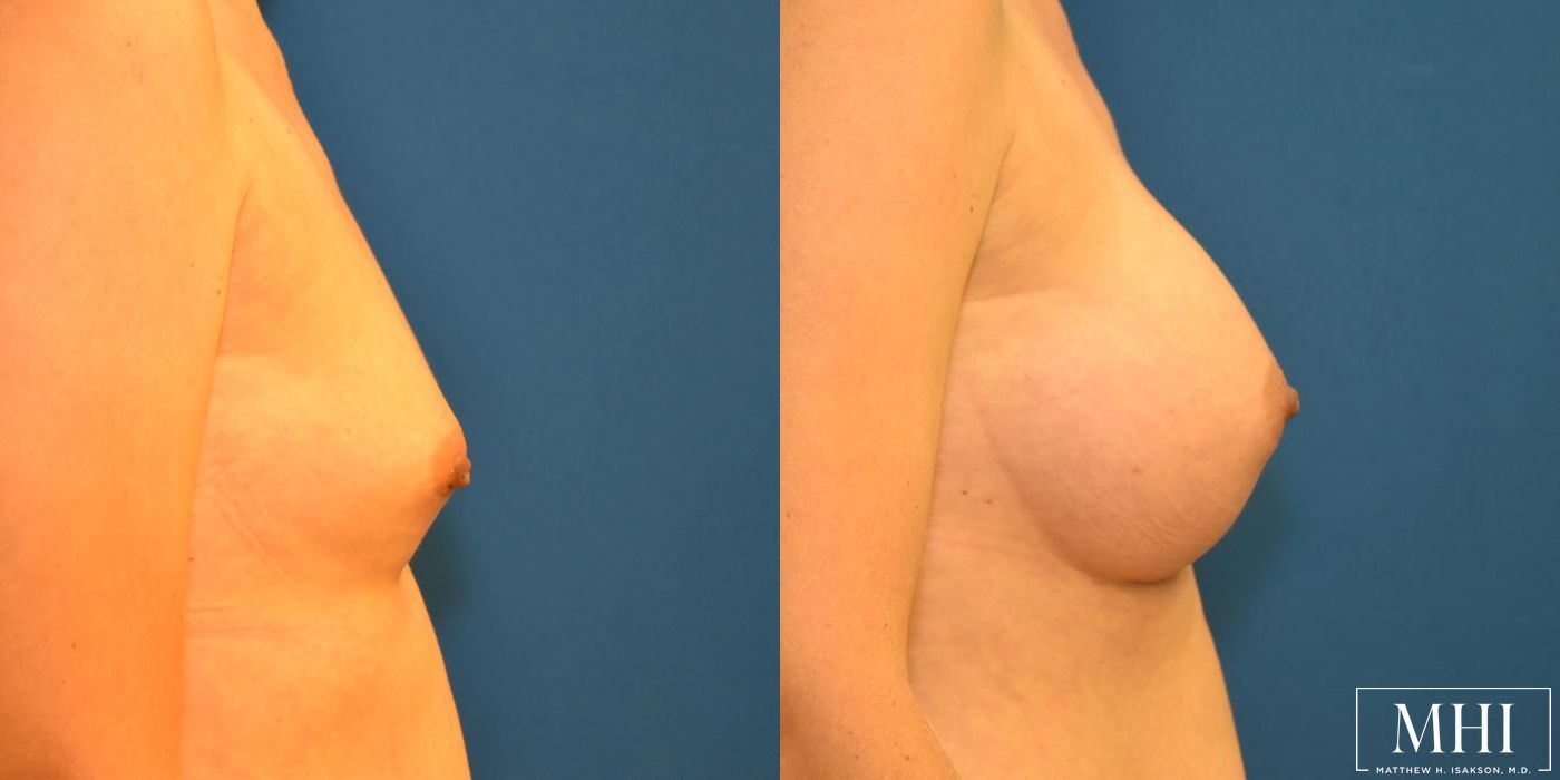 Breast Augmentation - Thumbnail 3