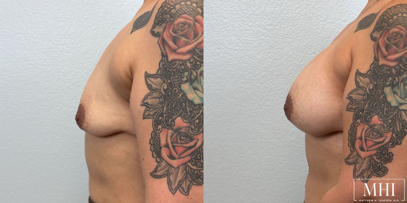 Breast Augmentation - Case 12428