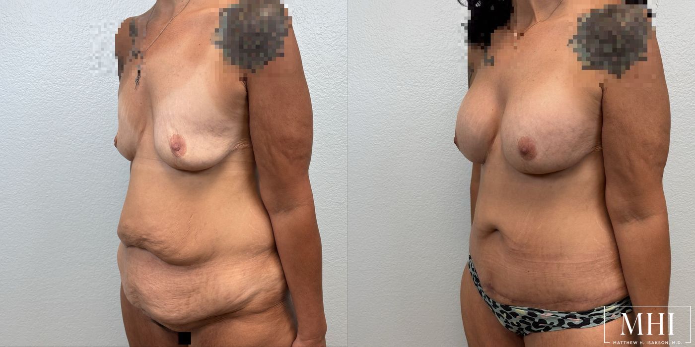 Breast Augmentation - Thumbnail 3