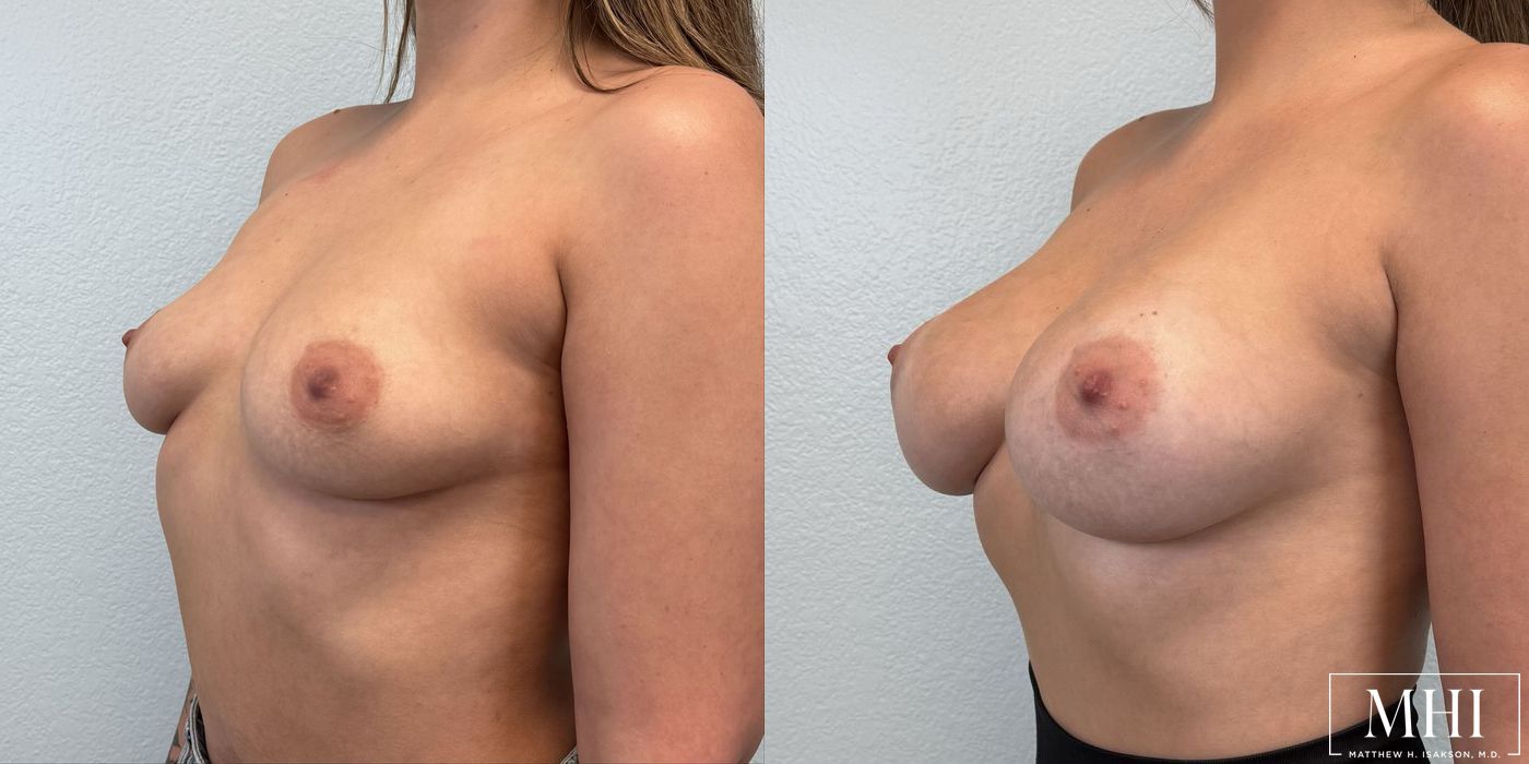 Breast Augmentation - Thumbnail 2