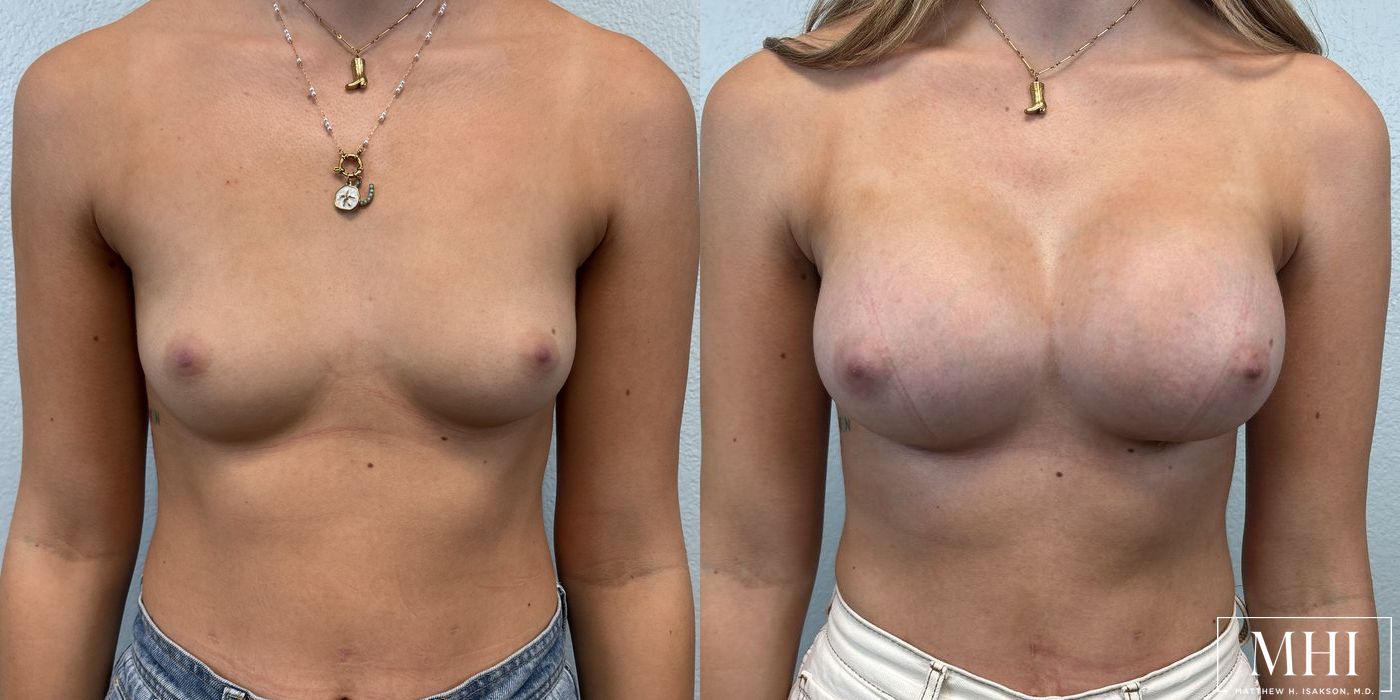 Breast Augmentation - Case 12111