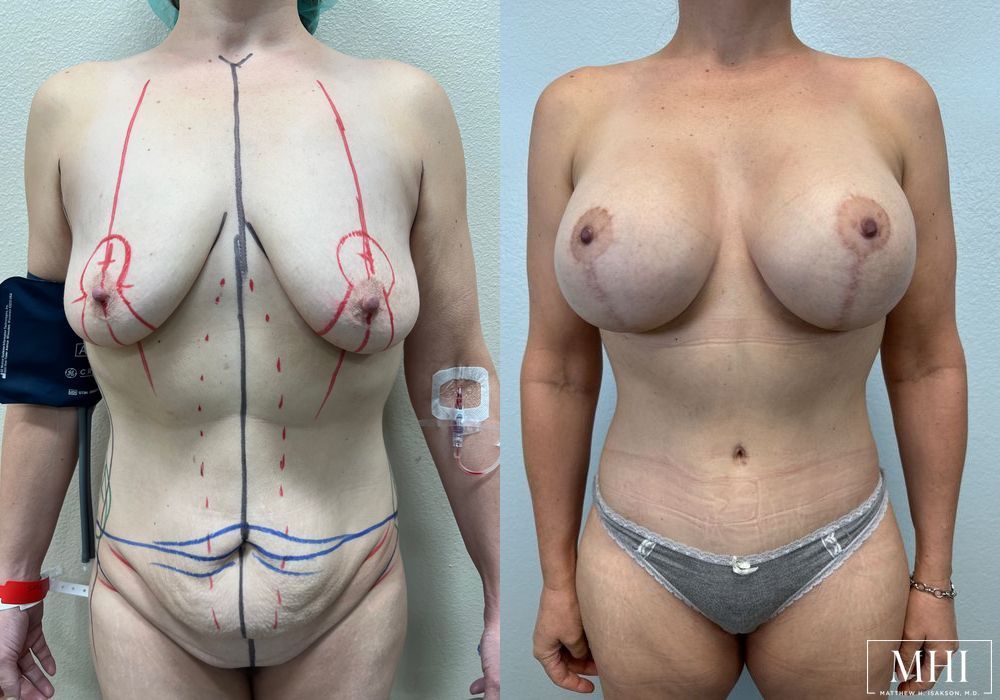 Breast Augmentation - Thumbnail 2