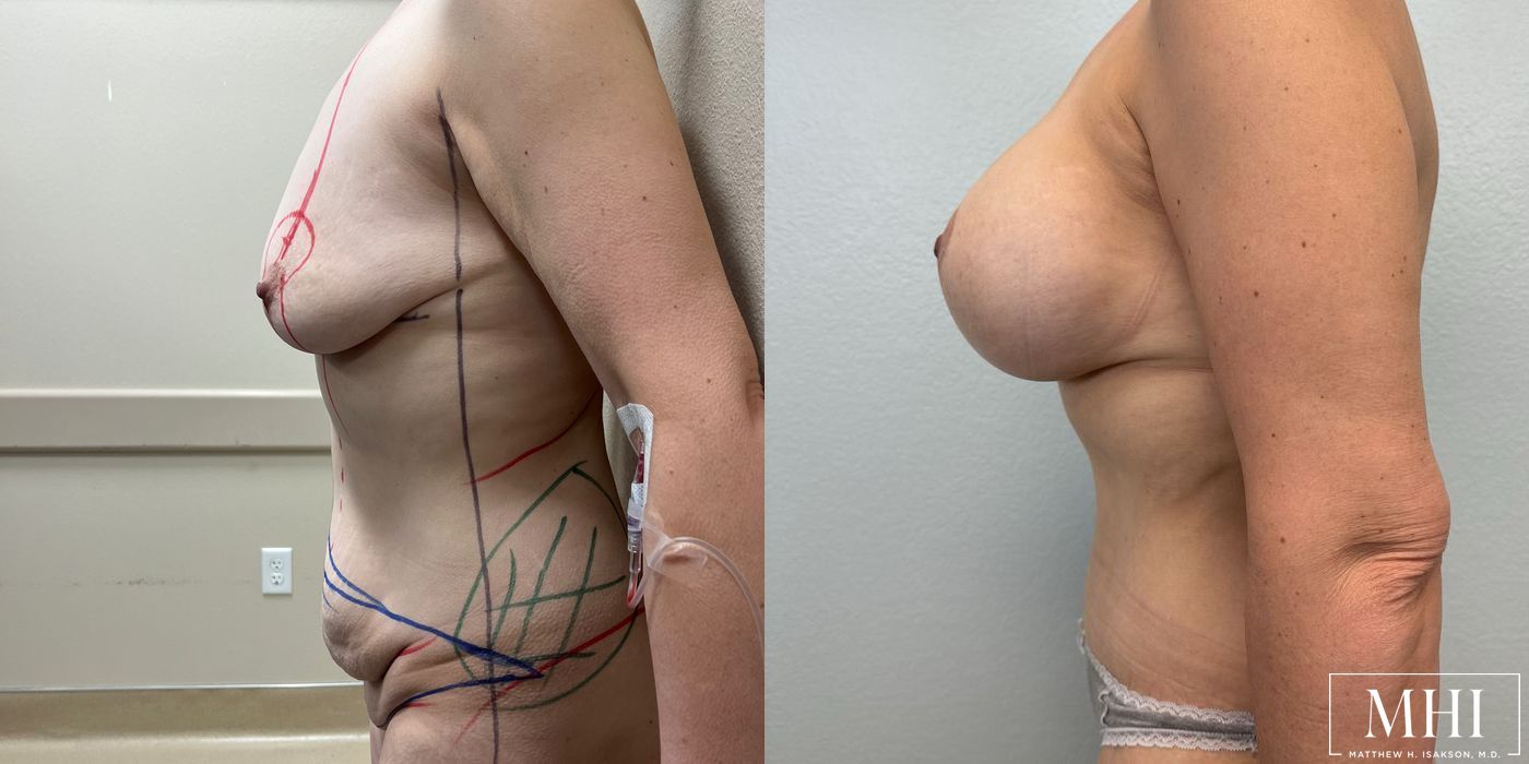 Breast Augmentation - Thumbnail 3