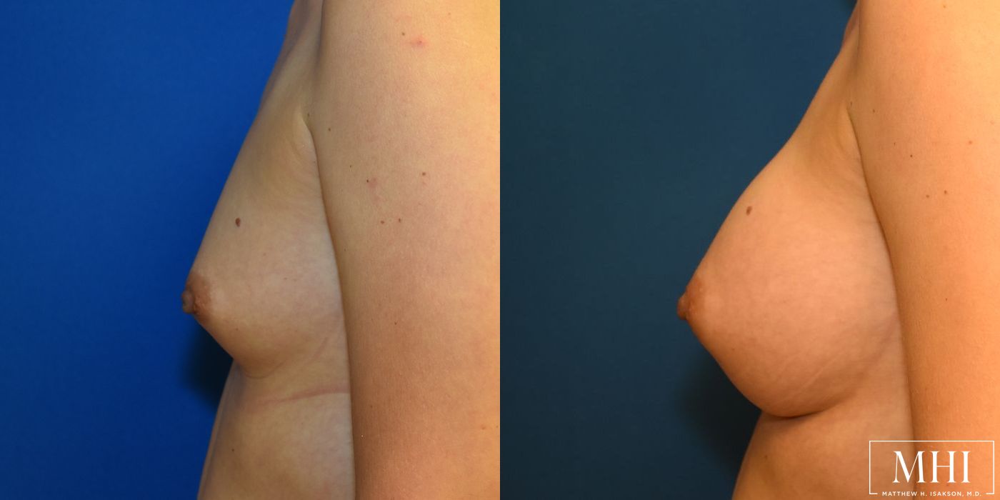 Breast Augmentation - Thumbnail 5
