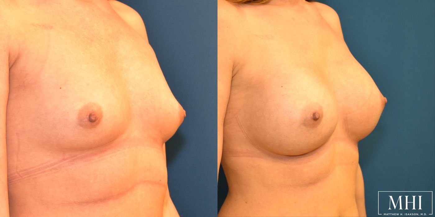 Breast Augmentation - Thumbnail 4