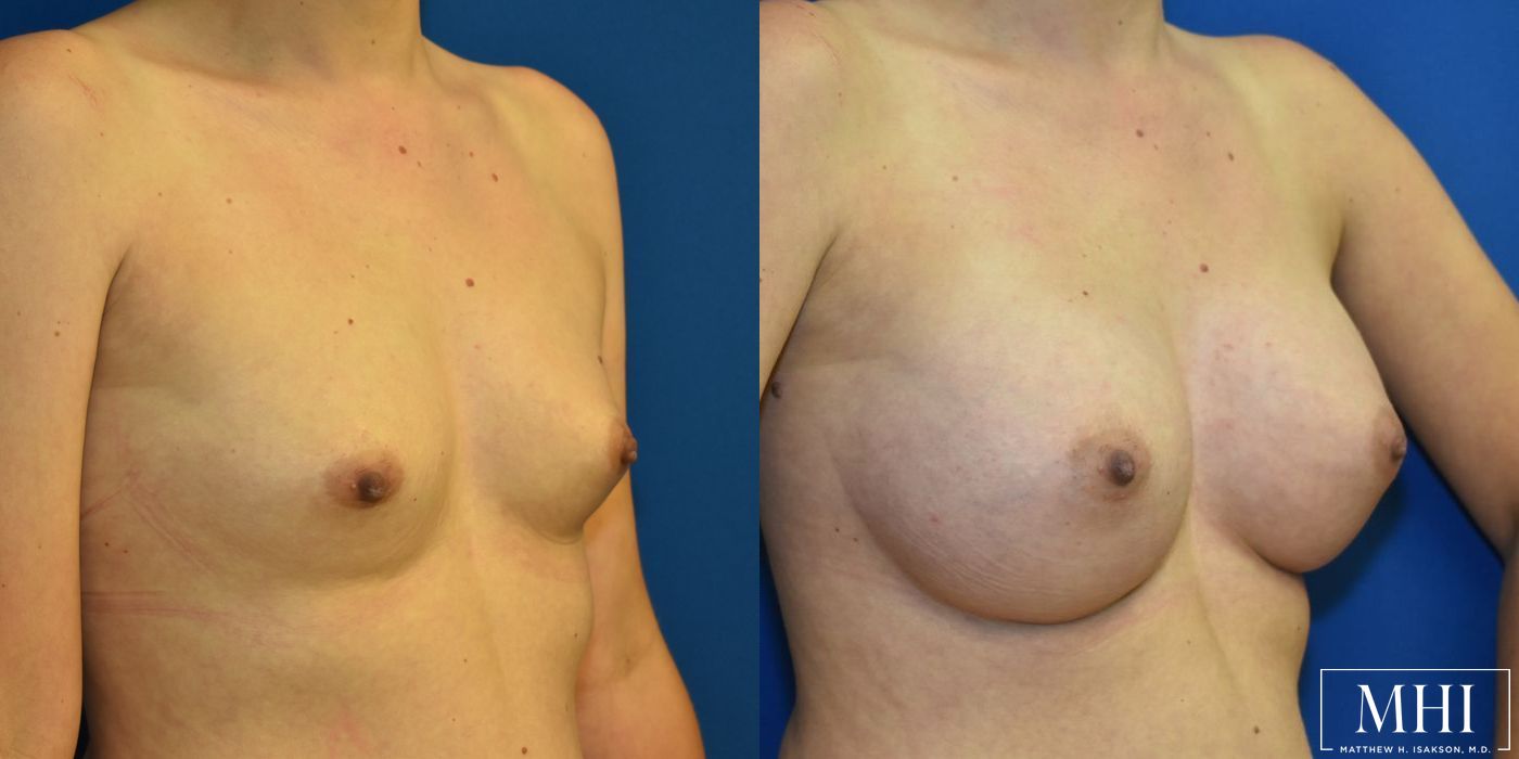 Breast Augmentation - Thumbnail 2