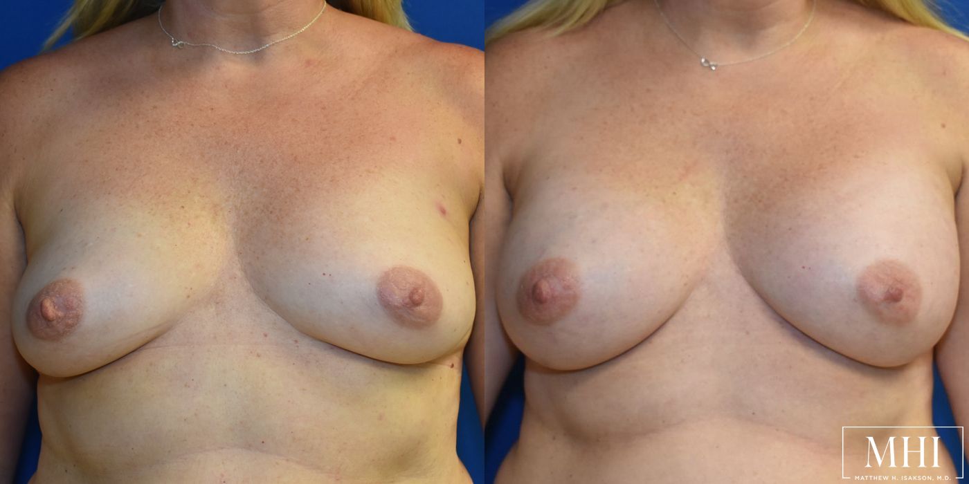 Breast Augmentation - Thumbnail 3