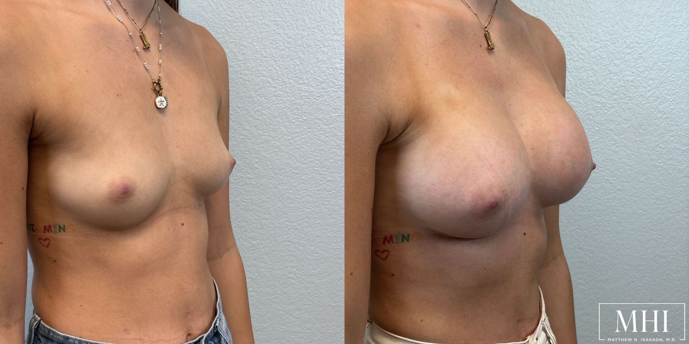 Breast Augmentation - Thumbnail 3