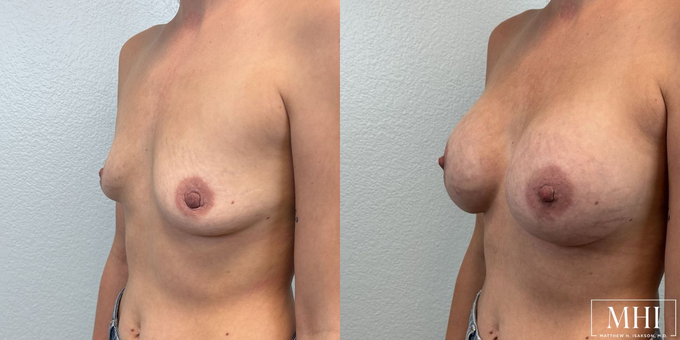 Breast Augmentation - Thumbnail 4