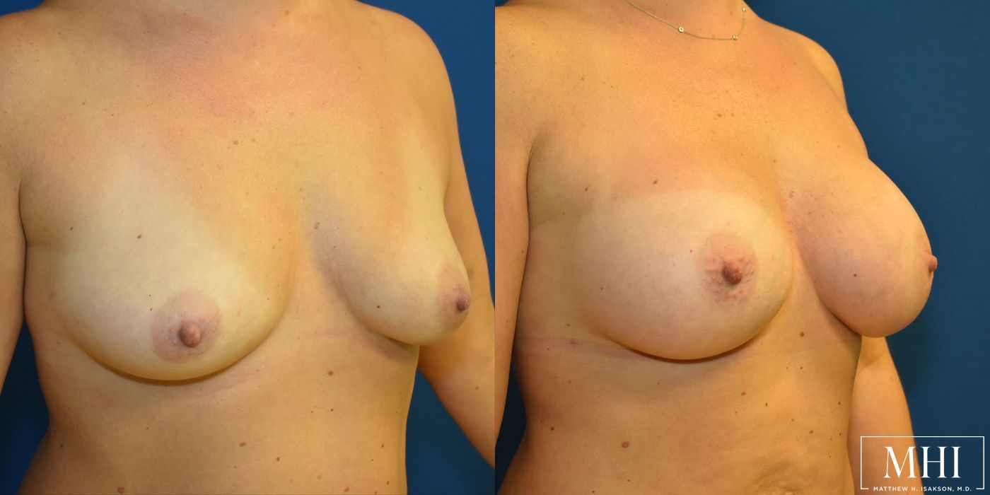 Breast Augmentation - Thumbnail 4