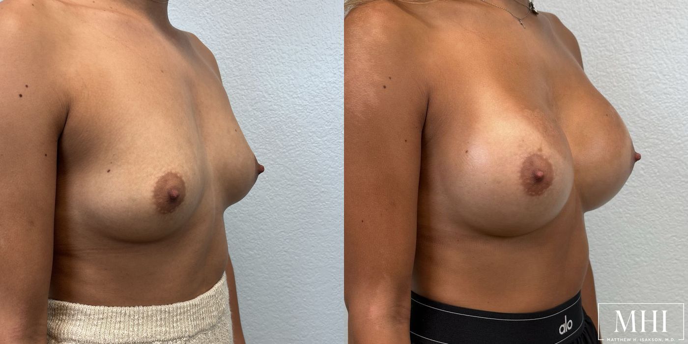 Breast Augmentation - Thumbnail 4