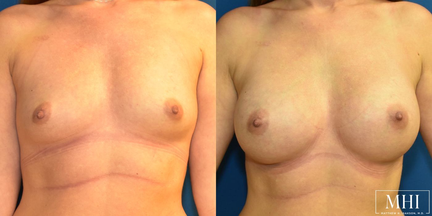 Breast Augmentation - Case 12438