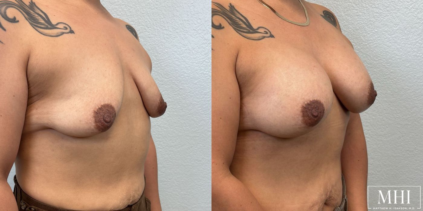 Breast Augmentation - Thumbnail 4