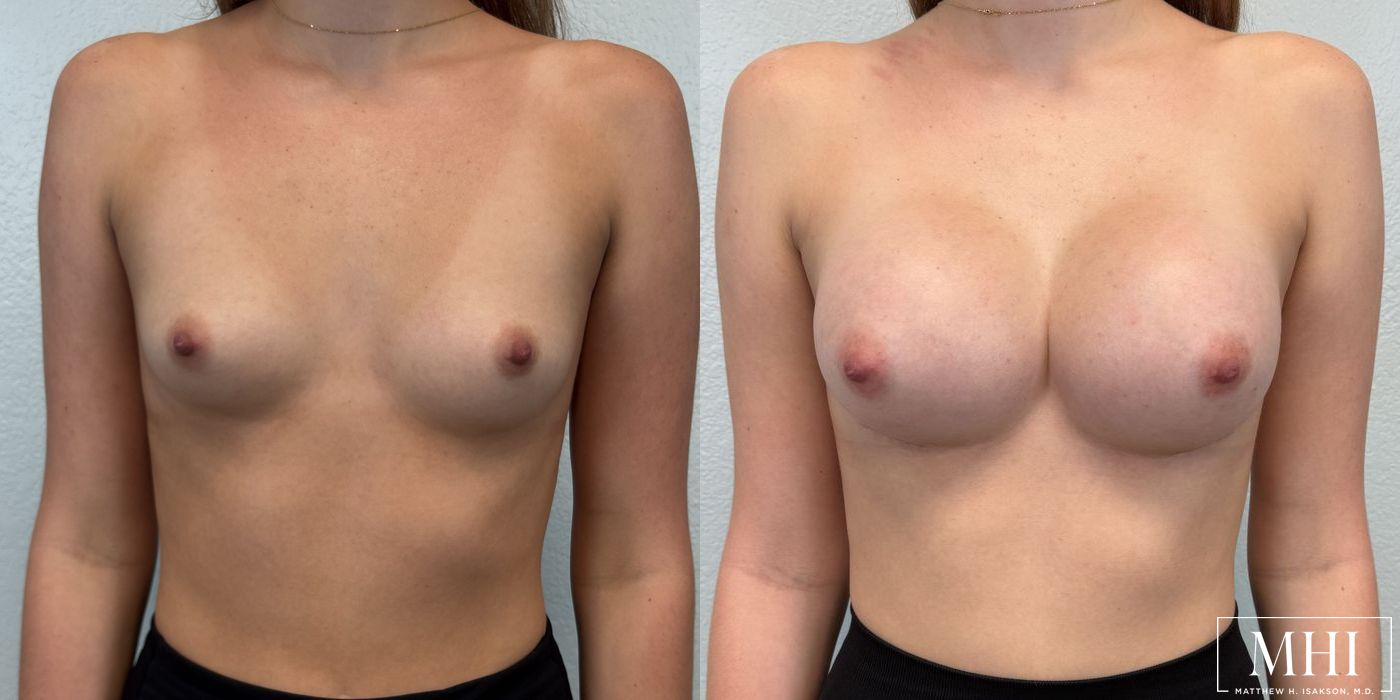 Breast Augmentation - Case 12114