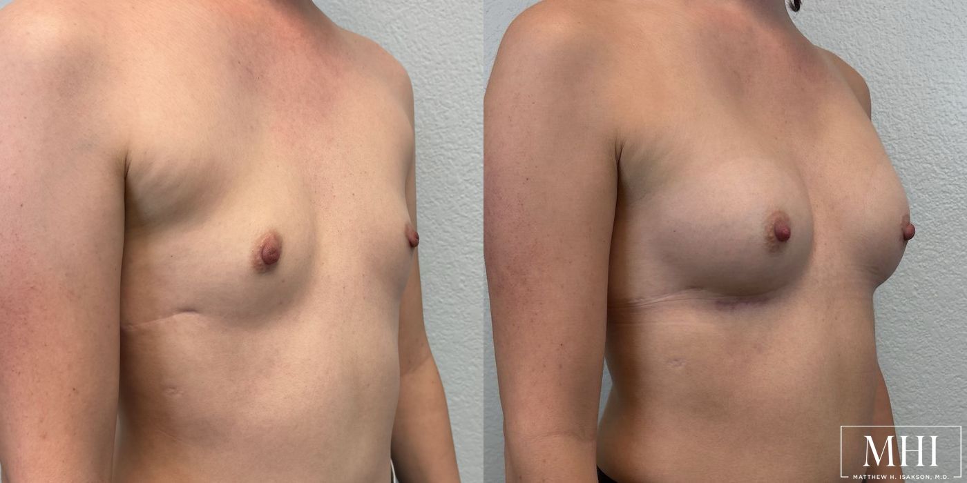 Breast Augmentation - Thumbnail 2