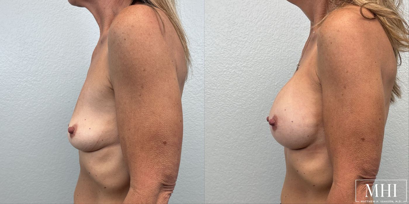 Breast Augmentation - Thumbnail 3