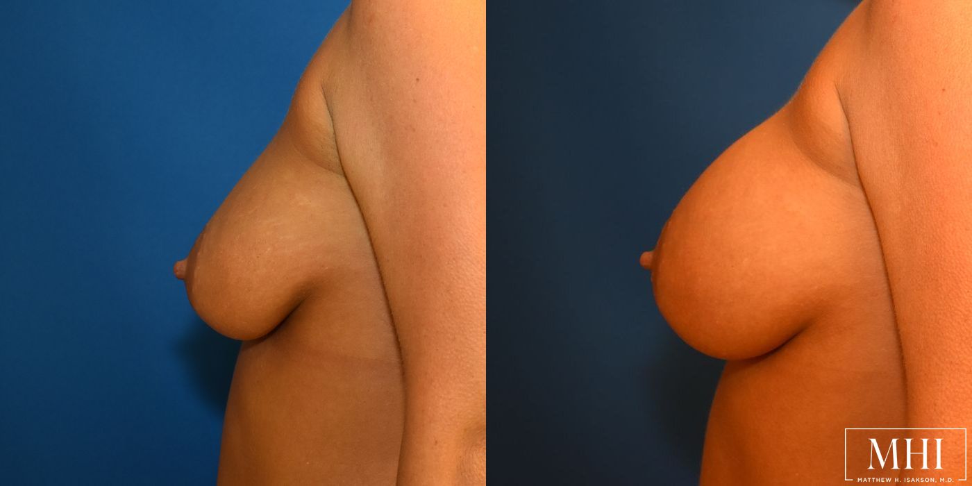 Breast Augmentation - Thumbnail 3