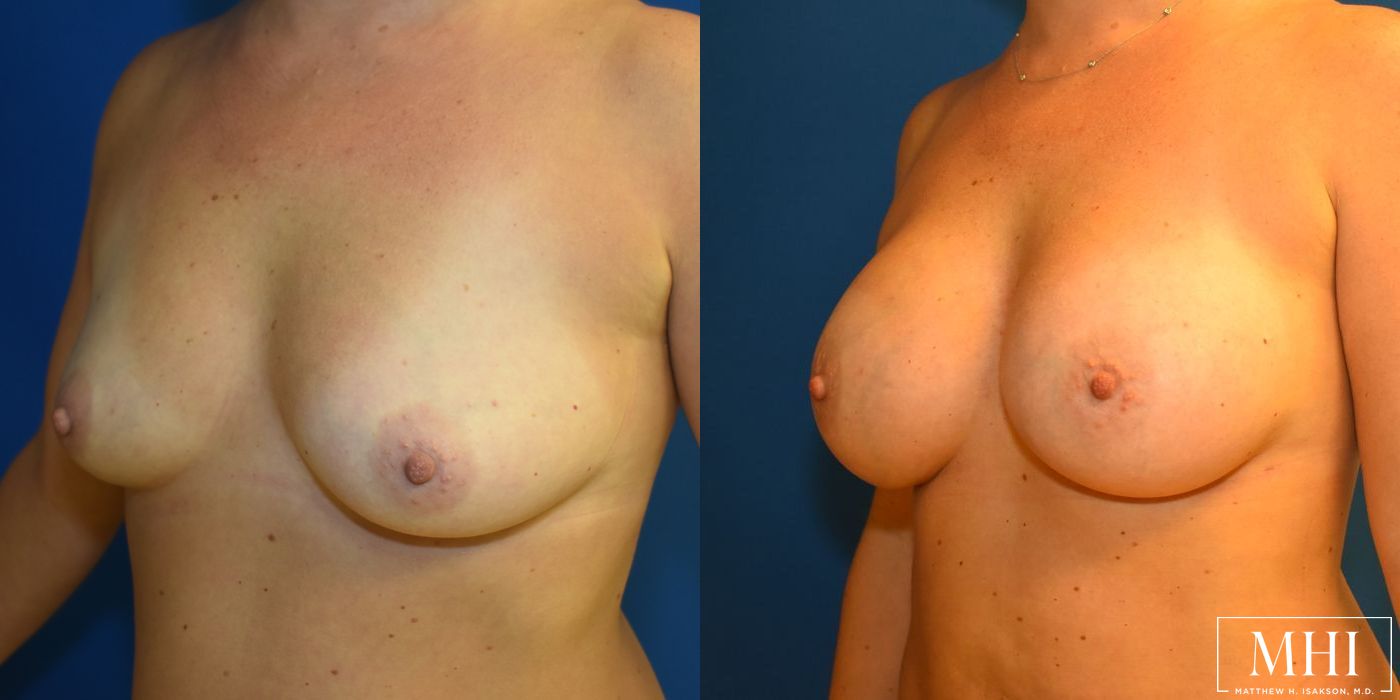 Breast Augmentation - Thumbnail 2