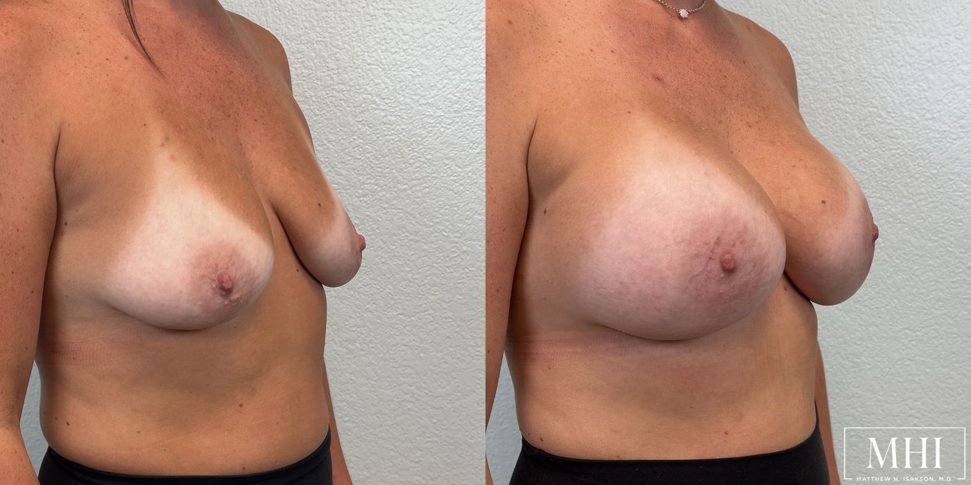 Breast Augmentation - Thumbnail 4