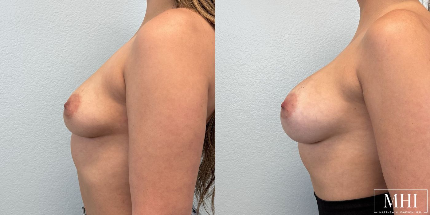 Breast Augmentation - Thumbnail 3