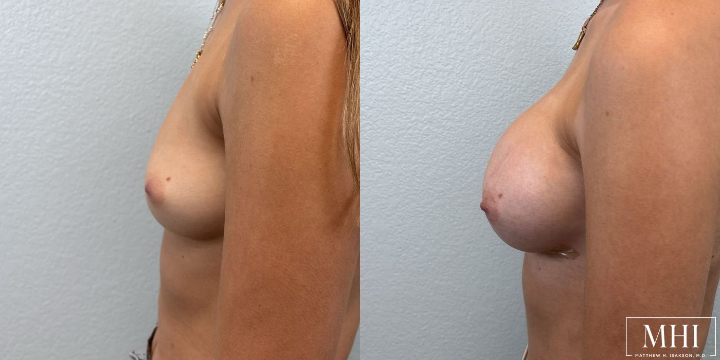 Breast Augmentation - Thumbnail 5