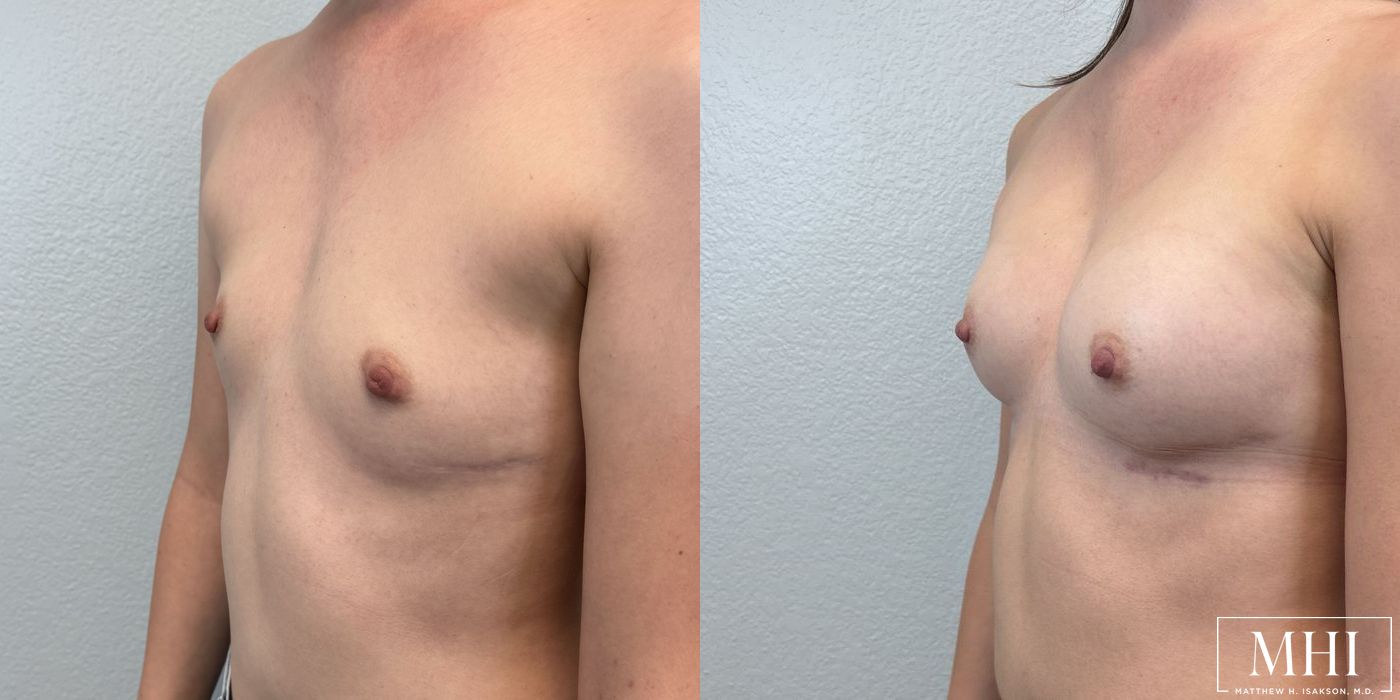 Breast Augmentation - Thumbnail 4