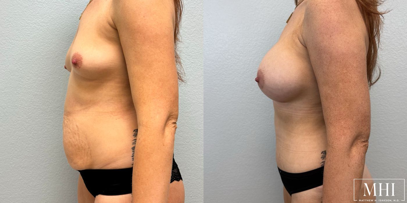 Breast Augmentation - Thumbnail 3