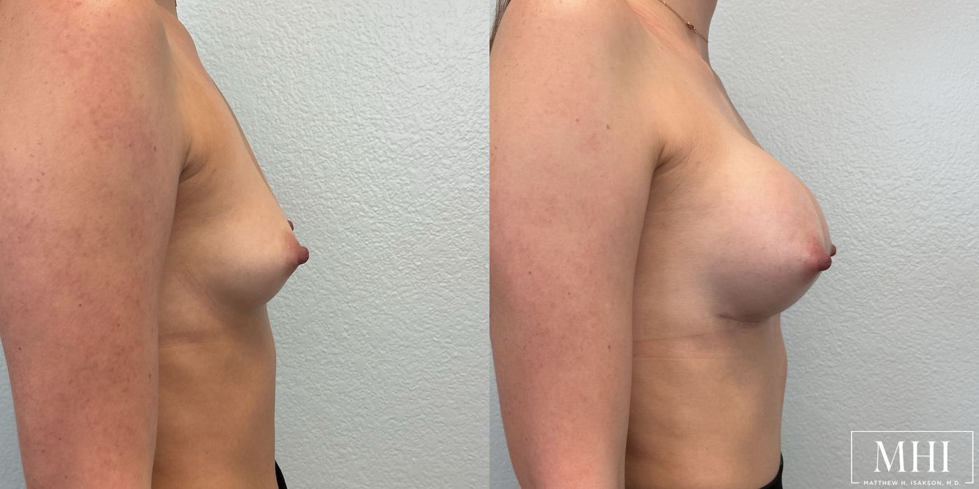 Breast Augmentation - Thumbnail 5