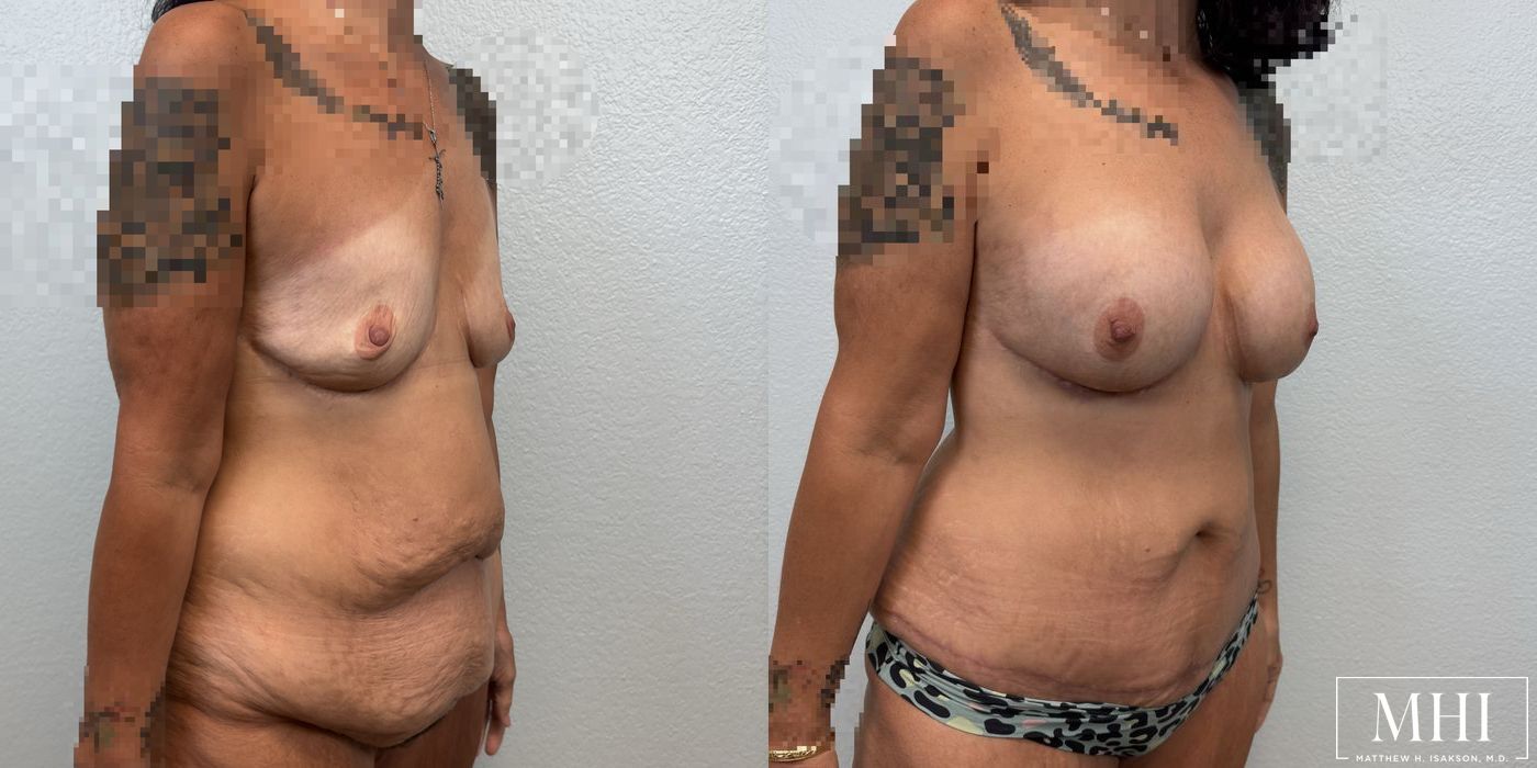 Breast Augmentation - Thumbnail 2