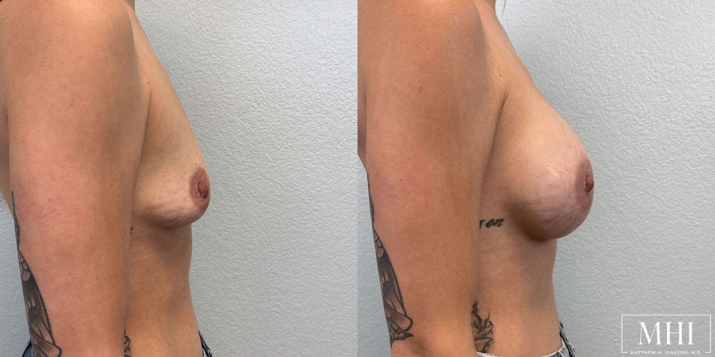 Breast Augmentation - Thumbnail 3