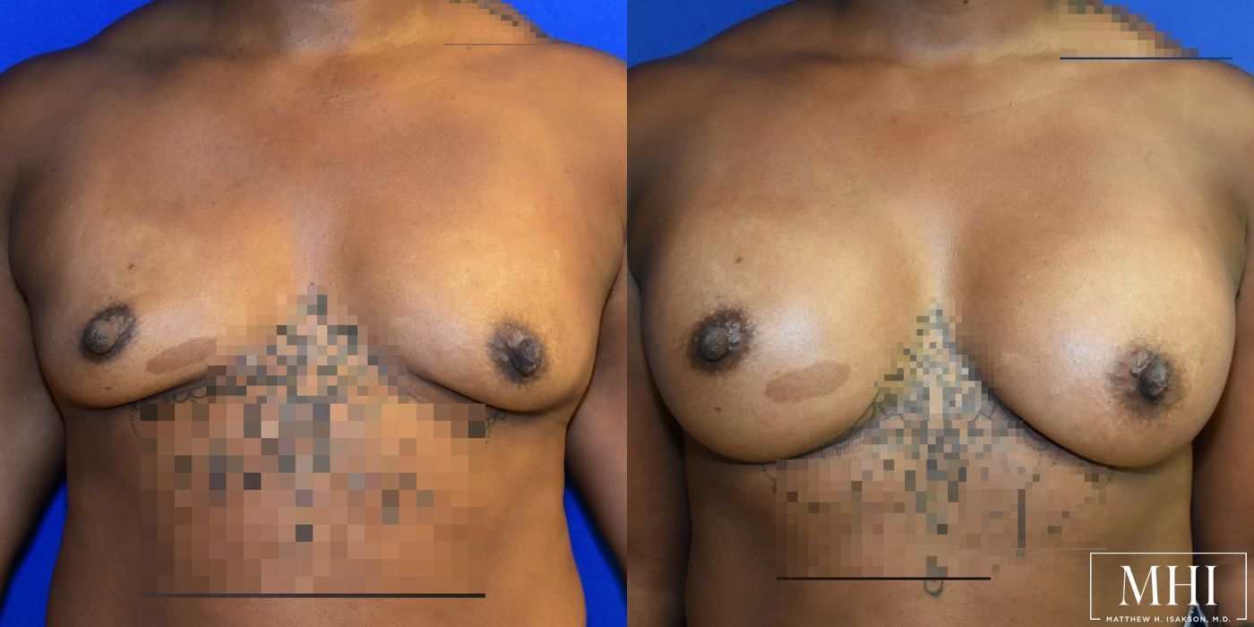 Breast Augmentation - Thumbnail 3