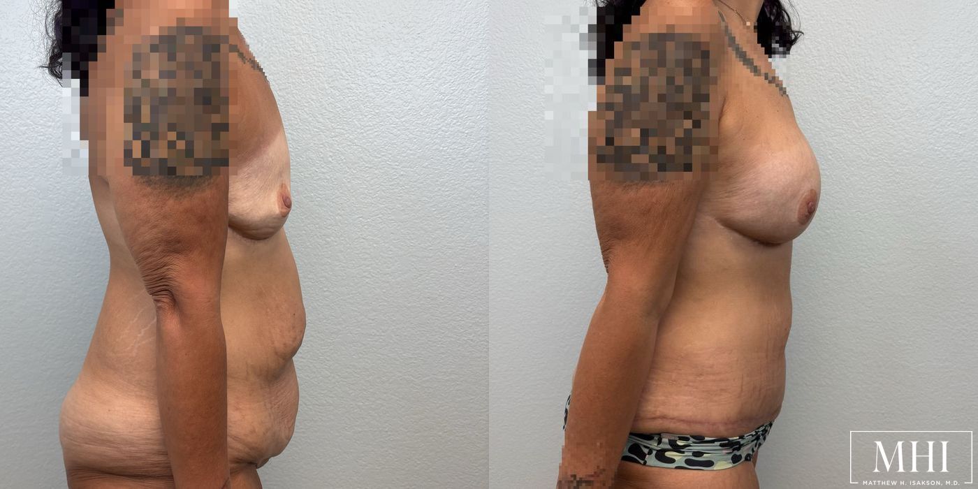 Breast Augmentation - Thumbnail 4