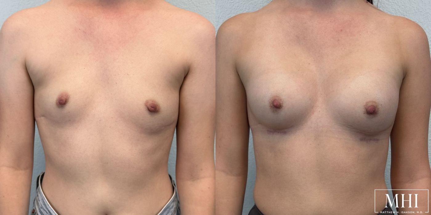 Breast Augmentation - Thumbnail 5