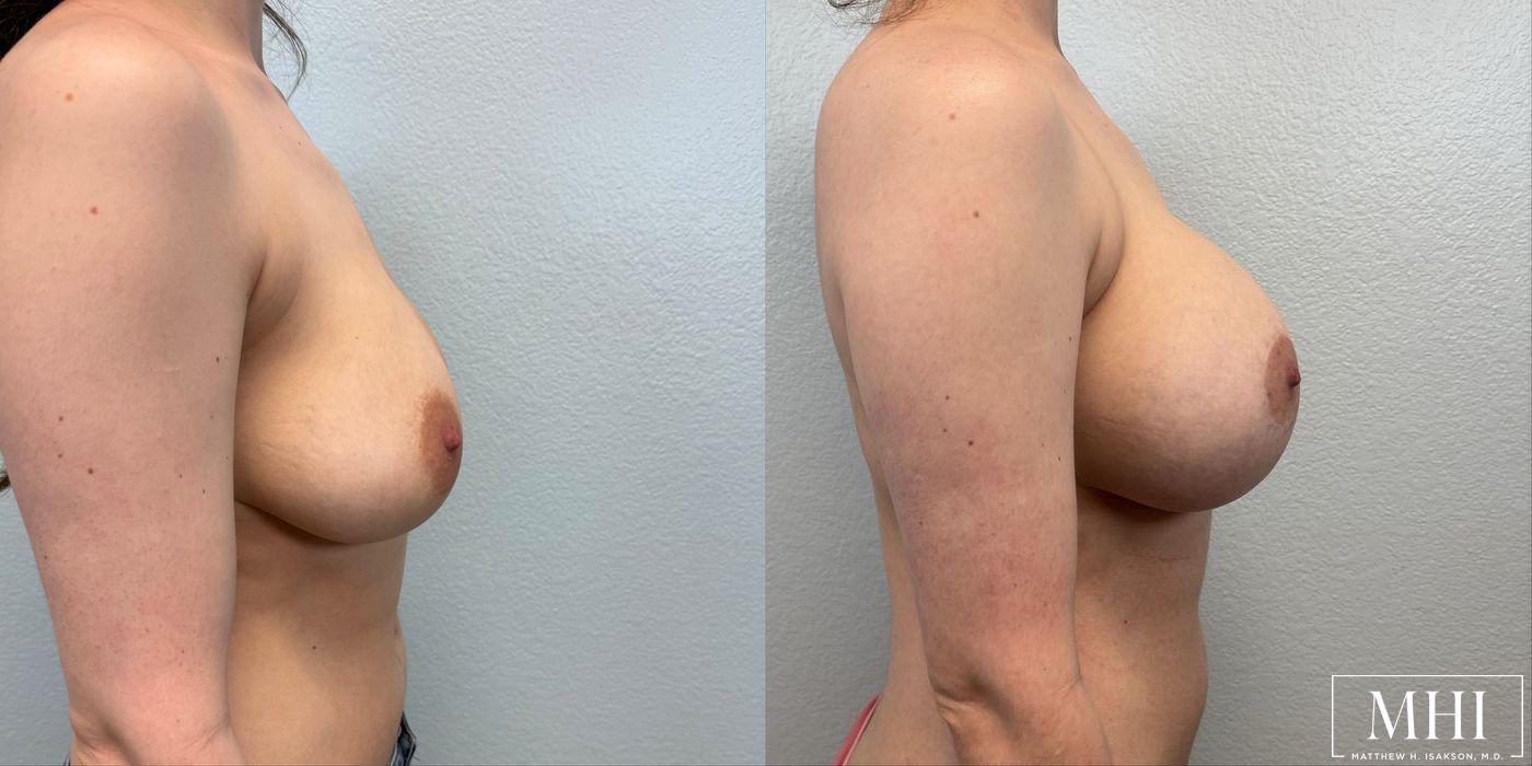 Breast Augmentation with Lift - Thumbnail 5