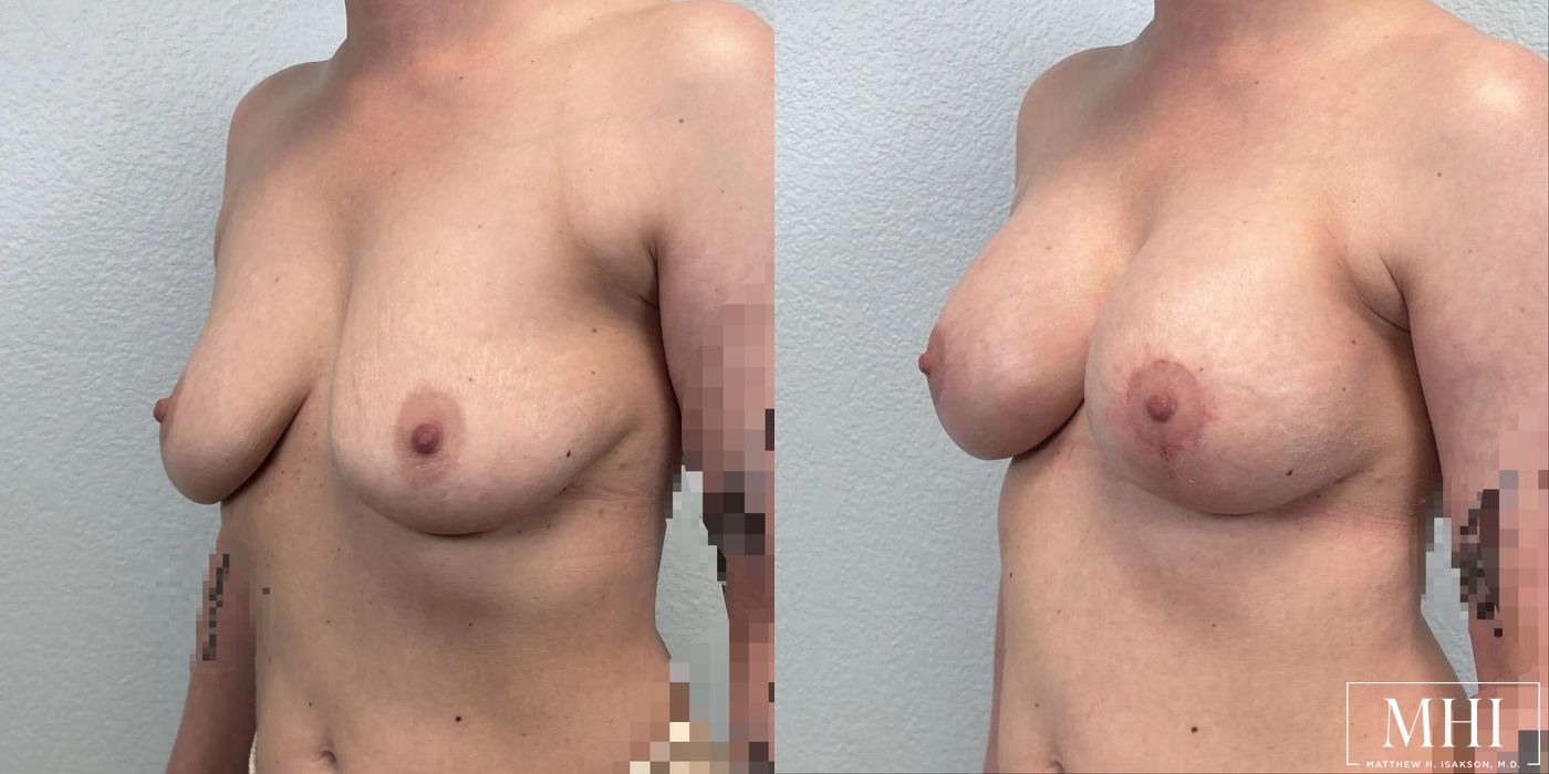 Breast Augmentation with Lift - Case 12461
