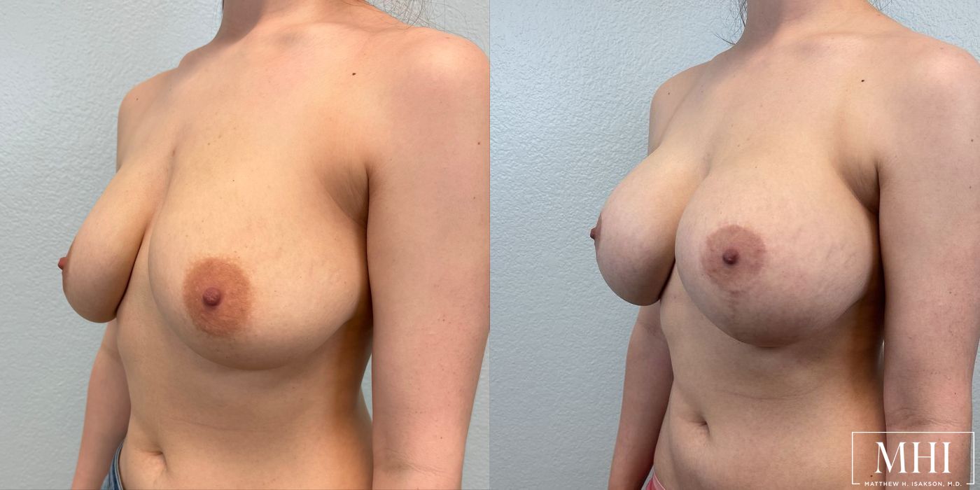 Breast Augmentation with Lift - Thumbnail 2