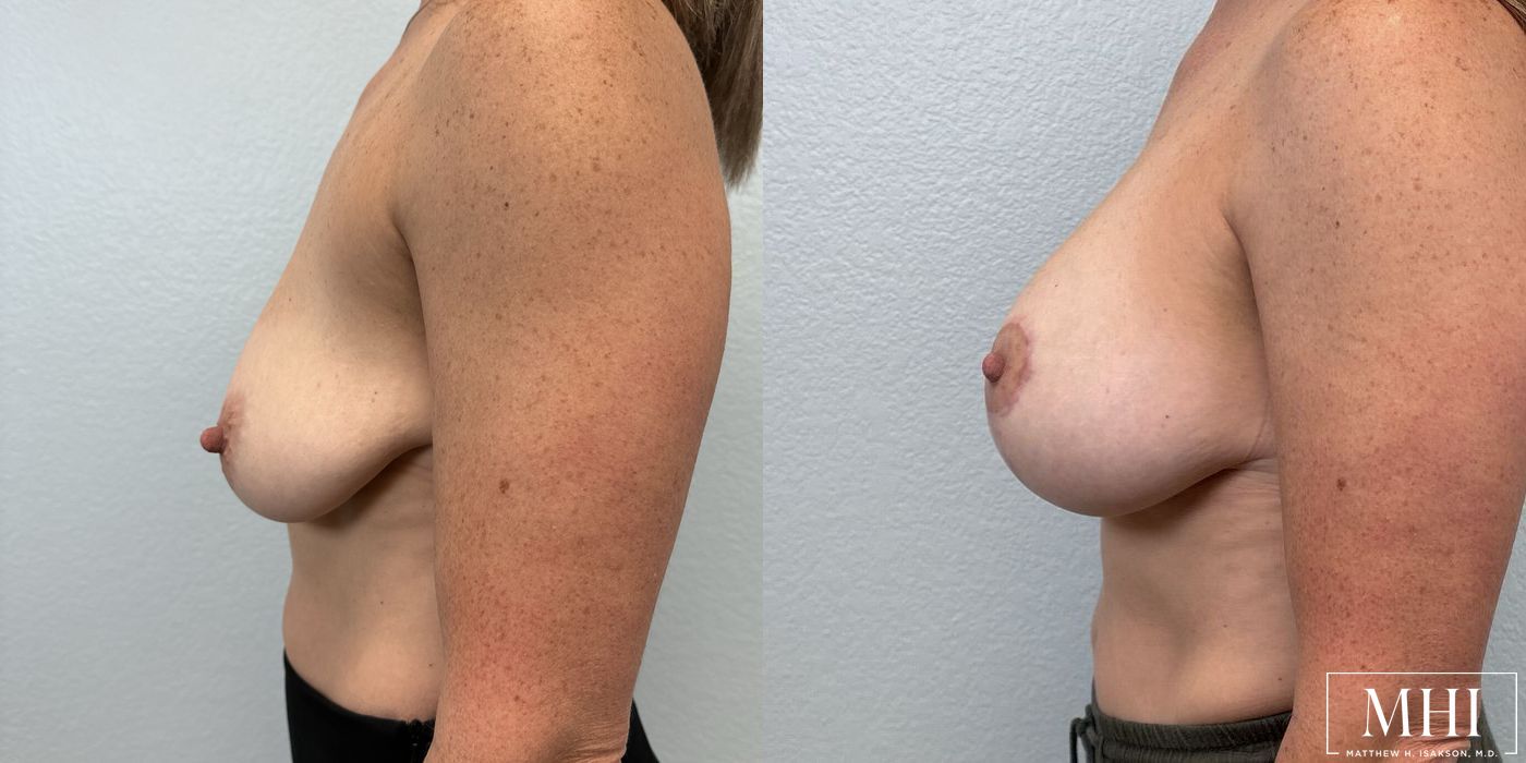 Breast Augmentation with Lift - Thumbnail 3
