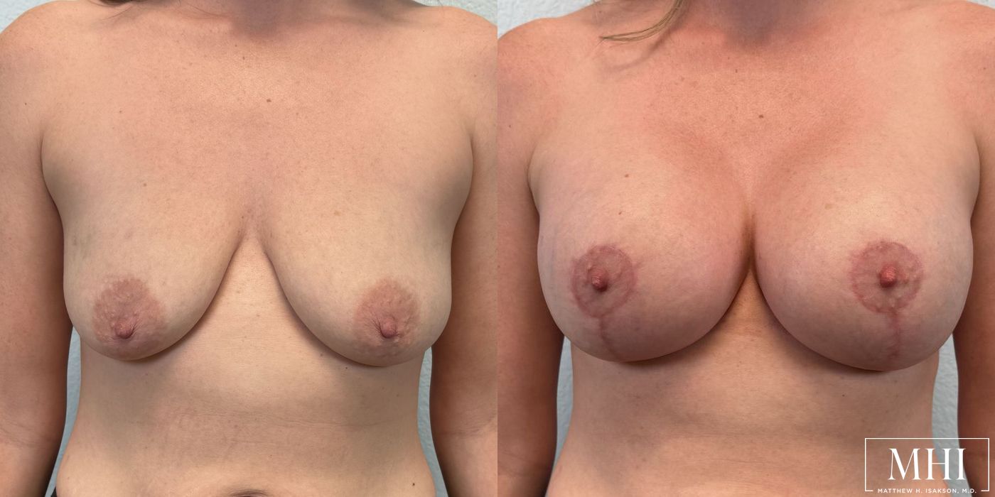 Breast Augmentation with Lift - Case 12131