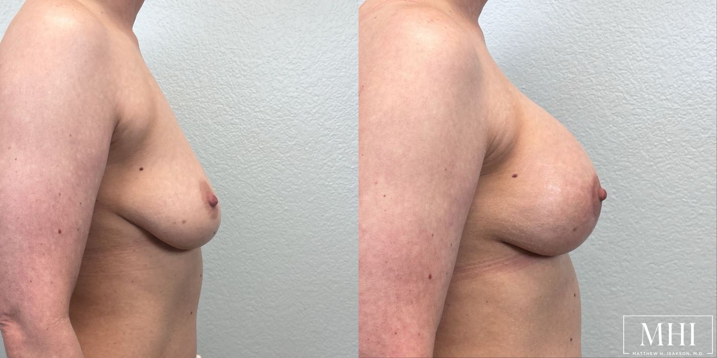Breast Augmentation with Lift - Thumbnail 5