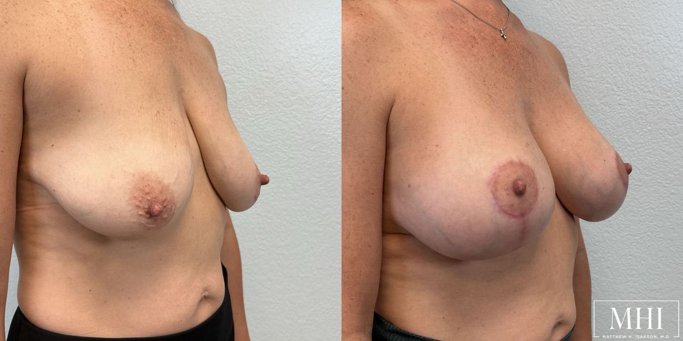 Breast Augmentation with Lift - Thumbnail 4