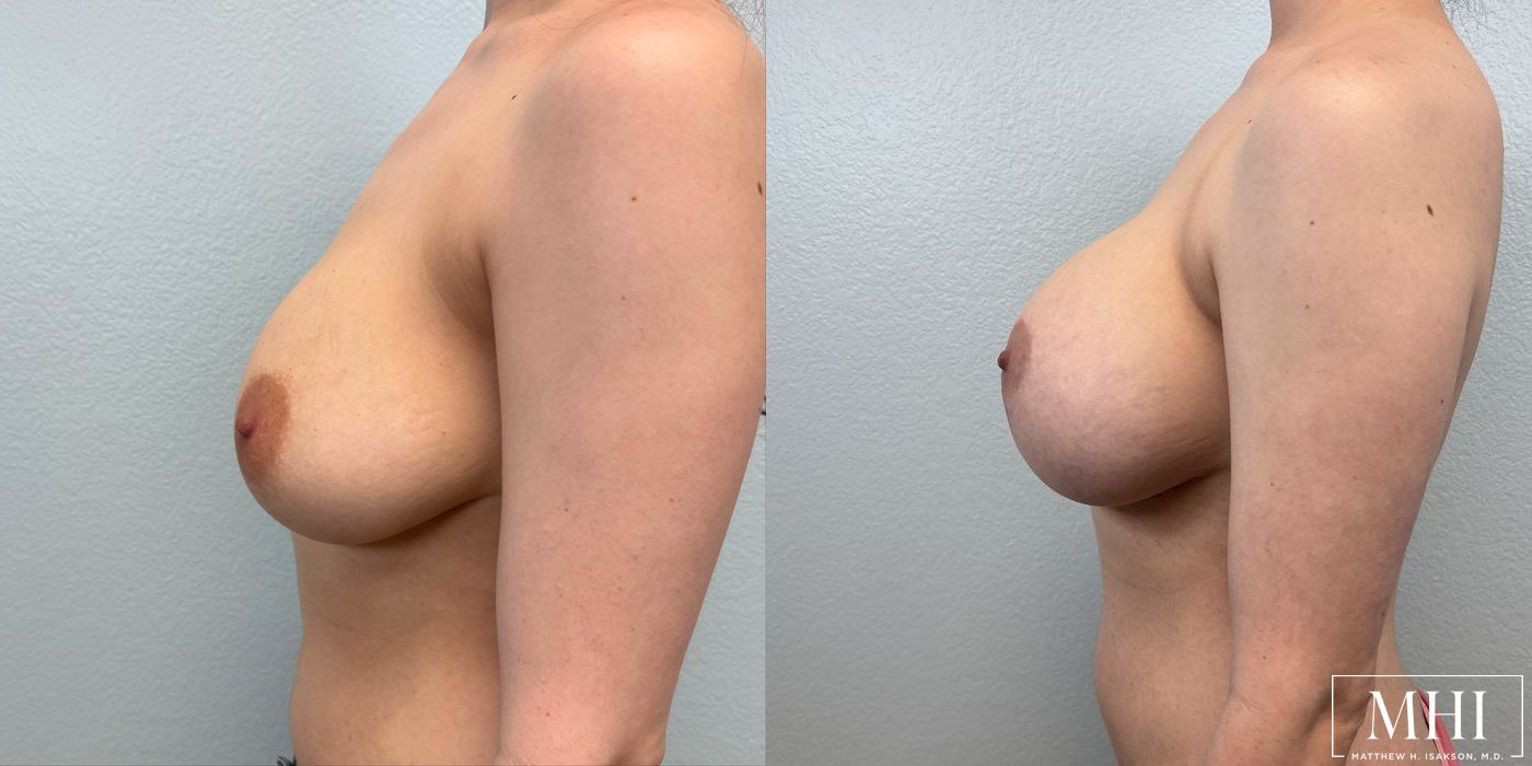 Breast Augmentation with Lift - Thumbnail 3