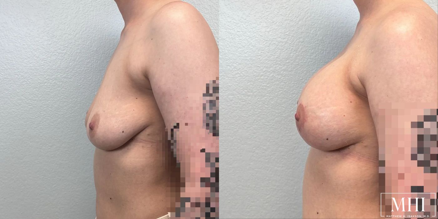 Breast Augmentation with Lift - Thumbnail 2