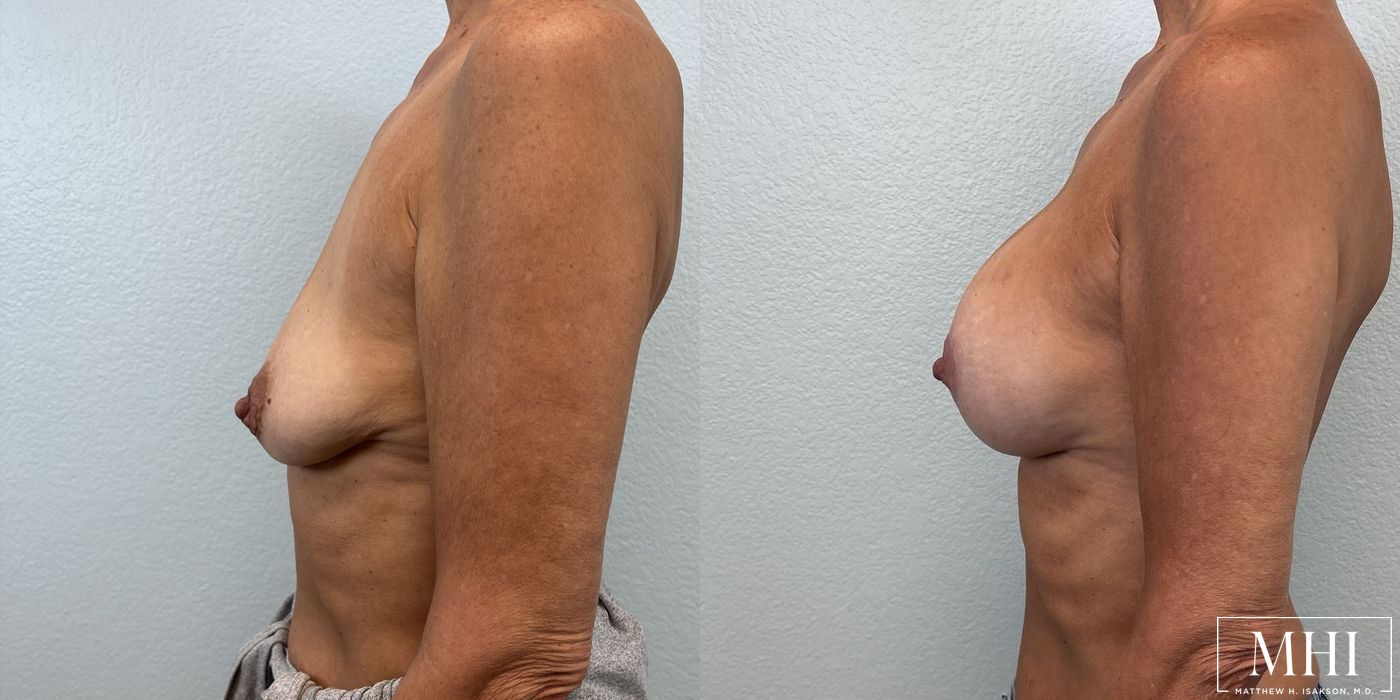 Breast Augmentation with Lift - Thumbnail 3