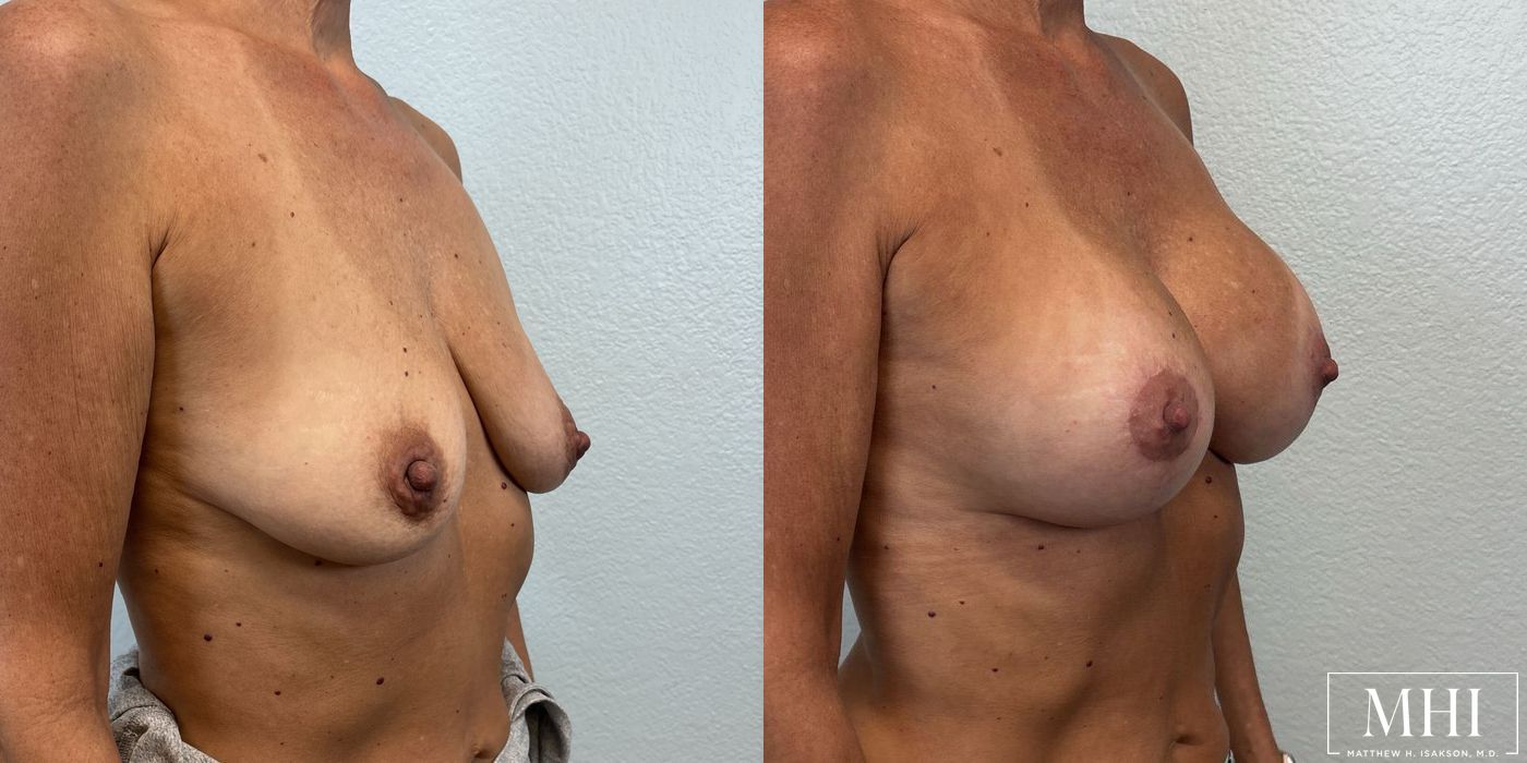 Breast Augmentation with Lift - Thumbnail 4