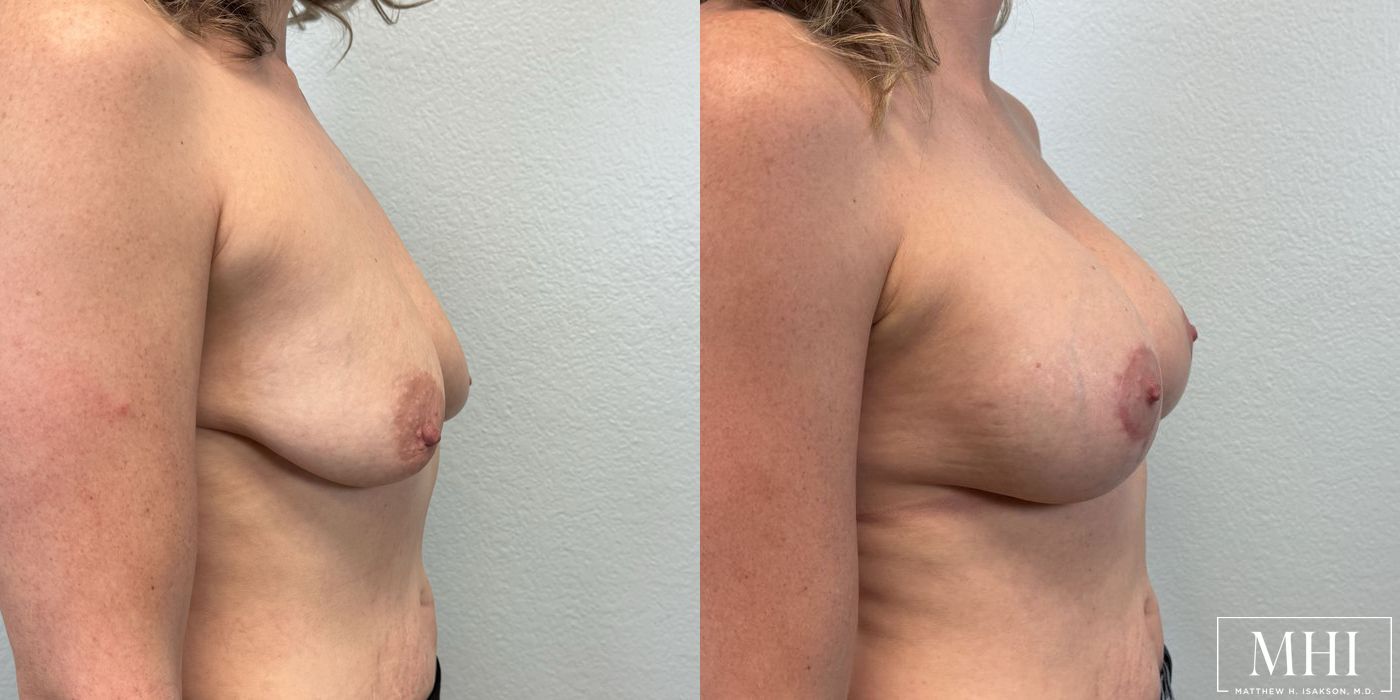 Breast Augmentation with Lift - Thumbnail 4