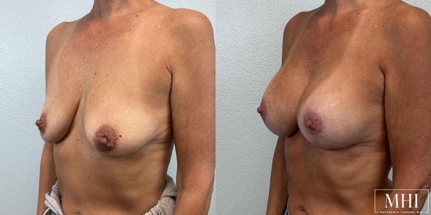 Breast Augmentation with Lift - Thumbnail 2