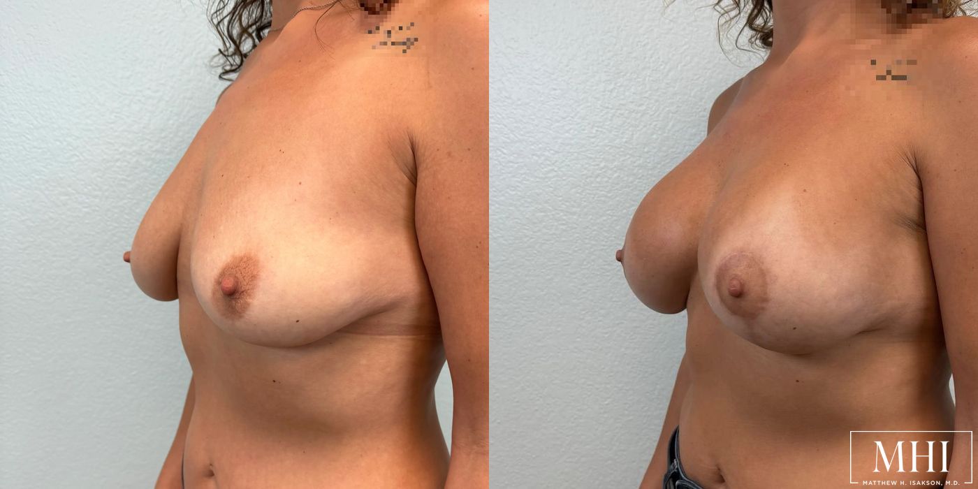 Breast Augmentation with Lift - Thumbnail 2